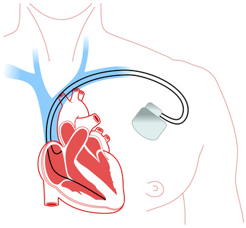 ペースメーカーのイメージ図