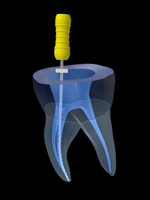 歯科の根管治療のイメージ